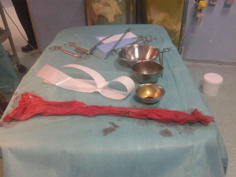 Le chirurgien oublie une compresse lors d’une césarienne : récit d’un drame évité de justesse