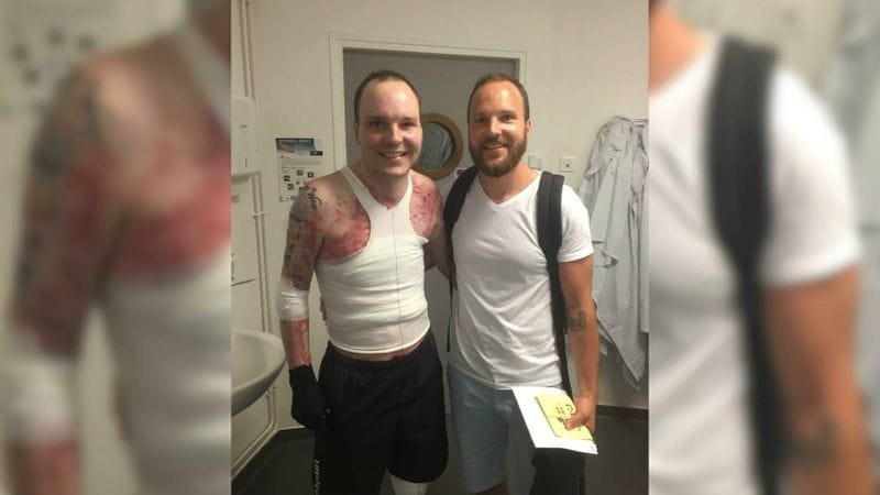 Un grand brûlé survit grâce à une greffe de peau de son jumeau
