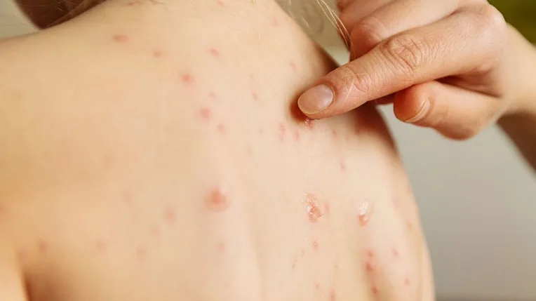 L’épidémie de la rougeole est en recul, selon le ministère de la Santé