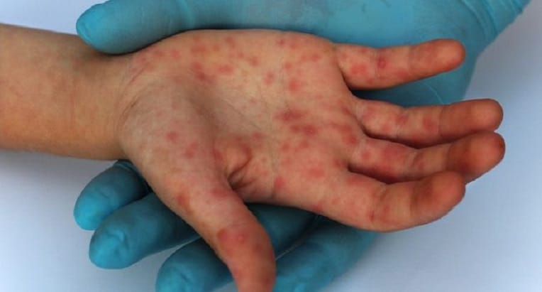 Tissemsilt : mort d’un enfant atteint « vraisemblablement » de rougeole