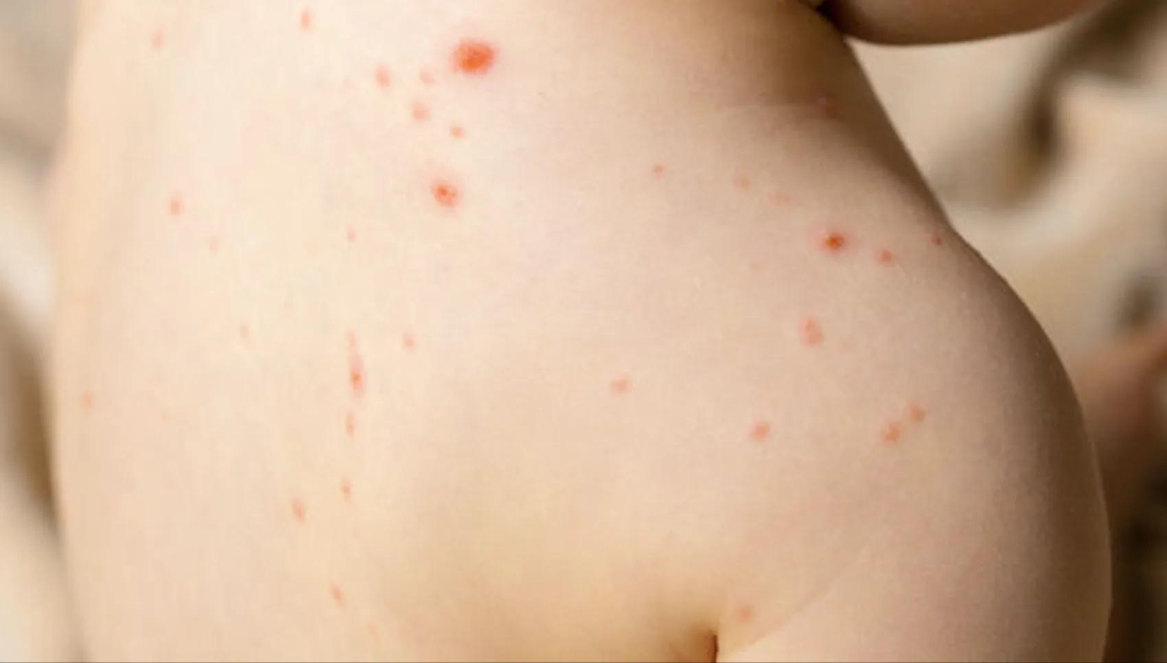 La rougeole s’étend en France