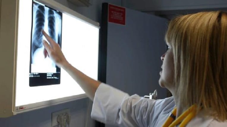 Santé : une avancée prometteuse dans le traitement du cancer du poumon