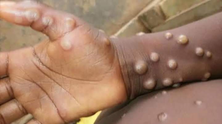 Variole du singe : l’Algérie prend ses devants