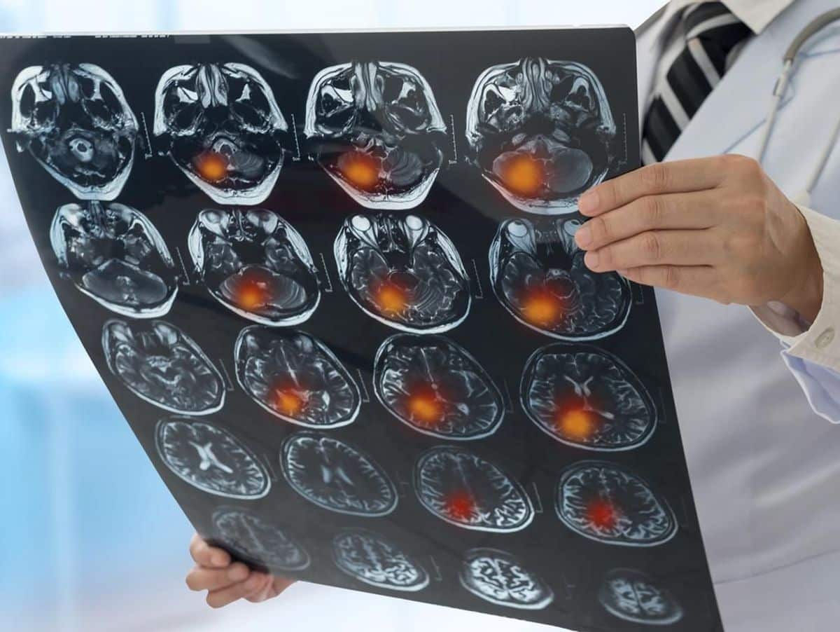 Comment reconnaître les premiers signes d&rsquo;alerte d&rsquo;un AVC